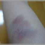 【ガチで怖い家庭の医学】生理の出血が多くなり、原因不明のあざができ始めた嫁。大したことないと思って放置してたら…